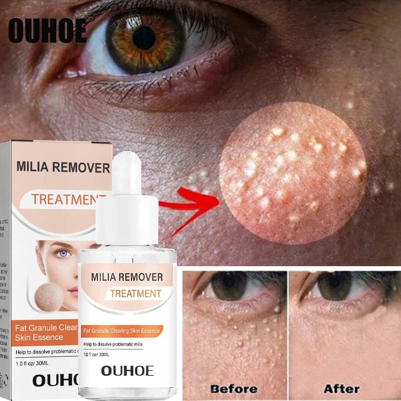 Fat Granules Removal Eye Serum Anti Dark Circle Eye Bags Fade Fine Line Essence Anti-Puffiness Moisturizing Skin Care Products - Boutique Beauté Santé 